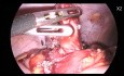 Difficult Sub-Hepatic Appendectomy