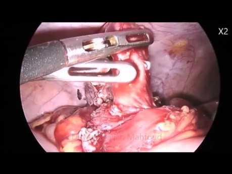 Difficult Sub-Hepatic Appendectomy