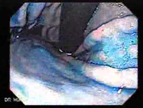 Hyperplastic Polyp - Endoscopy (3 of 8)
