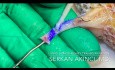 End-to-side Anastomosis Upper Polar Artery to Renal Artery