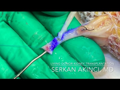 End-to-side Anastomosis Upper Polar Artery to Renal Artery