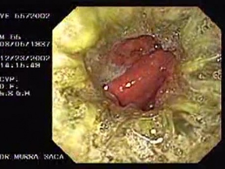Zollinger- Ellison Syndrome - Gastric Ulcer with Gastrocolic Fistula (21 of 21)