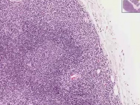Nodal marginal zone B-cell - Histopathology - Lymph node
