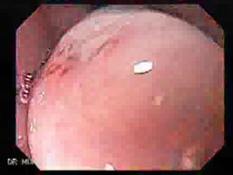 Large Gastric Varices (2 of 4)