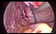 Laparoscopic Multiple Myomectomy
