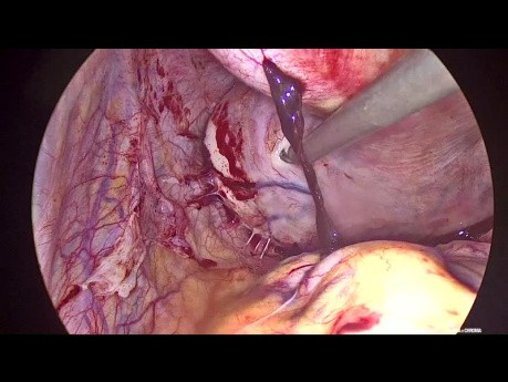 Laparoscopic Multiple Myomectomy