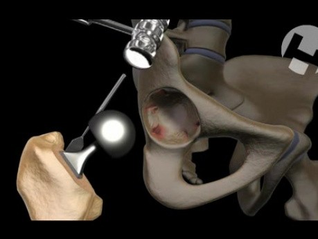 Future Total Hip Replacement Revision