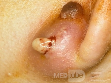 Infected Epidermal Inclusion Cyst [drained]