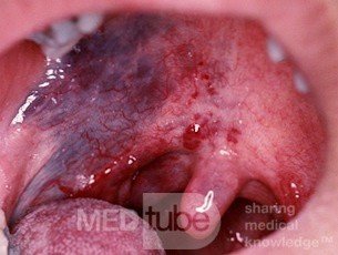 Vascular Malformation of the Palate