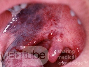 Vascular Malformation of the Palate