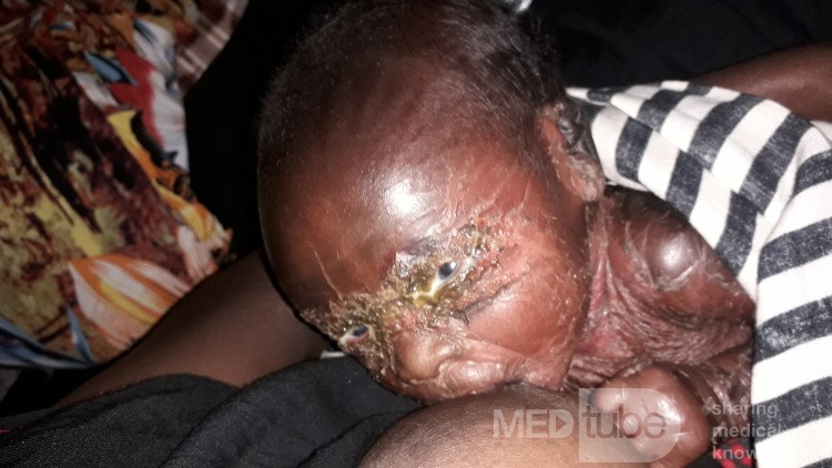 Sss Syndrome with Opthalmia Neotorum