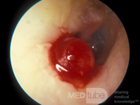 Granulation Tissue Exteral Canal