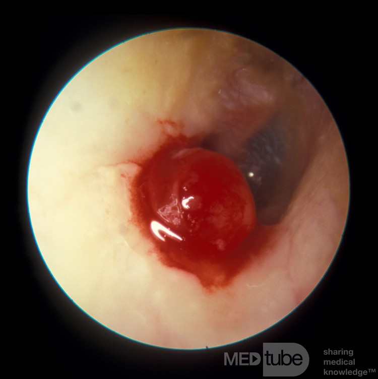 Granulation Tissue Exteral Canal • Picture • MEDtube.net