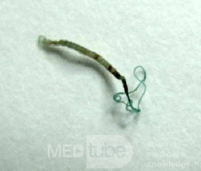 Trichuris Trichuris (whipworm) (5 of 10)