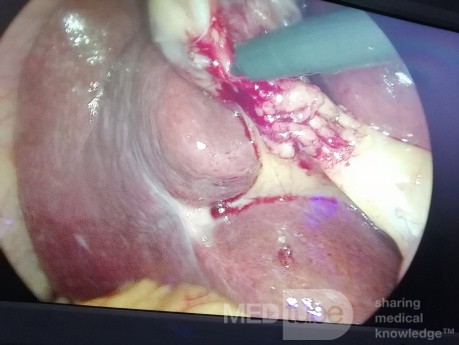 Cystic Artery Lies Posteriorly