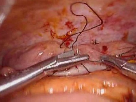 Colonic Perforation With Peritonitis - Laparoscopy (15 of 46)