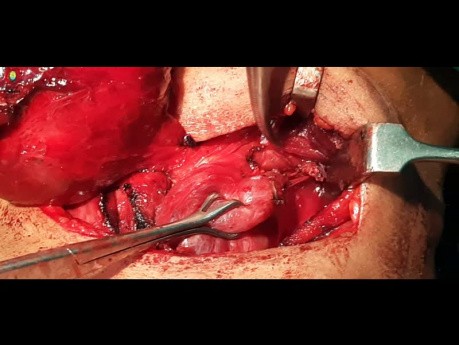 Thyroidectomy Injury