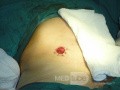 Multiple Rectal Ulcers (53 of 110)