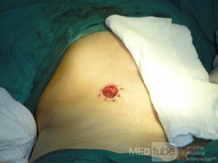 Multiple Rectal Ulcers (53 of 110)