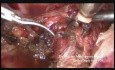 Difficult Hysterectomy After Radical Nephro Ureterectomy 