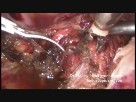 Difficult Hysterectomy After Radical Nephro Ureterectomy 