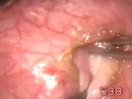 Inferior Oblique Myomectomy - 4 Steps