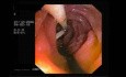 Stents In Bile Ducts In Gastroscopy