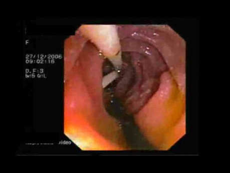 Stents In Bile Ducts In Gastroscopy