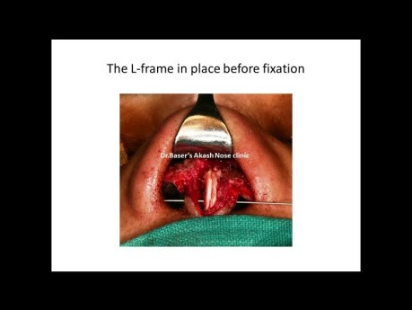 Binder's 6th Revision Rhinoplasty 
