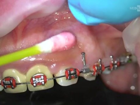 Mini Screw Removal in Orthodontics
