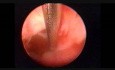 Endometrial Adenocarcinoma and Directed Biopsy