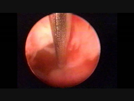 Endometrial Adenocarcinoma and Directed Biopsy