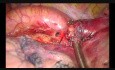 Upside Down Fissureless Technique for a Tumor Involving Fissure