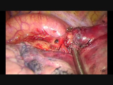 Upside Down Fissureless Technique for a Tumor Involving Fissure