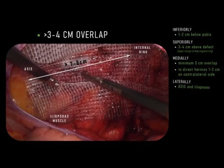 Mesh Overlap in TAPP - Tips How to Maintain Good Margins