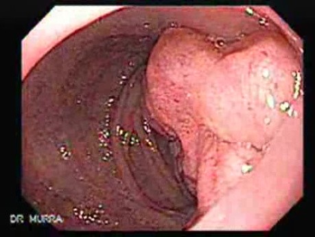 Gastric Lymphoma with Metastases to the Duodenum - 74 Years-Old Male