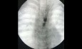 Post Esophageal Atresia Structure