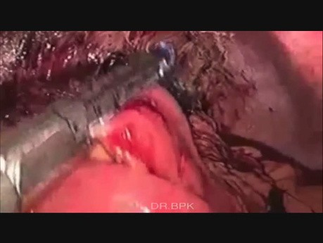 Laparoscopic Pancreatic Pseudocystojejunostomy