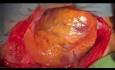 Off Pump CABG in patient with Colon Cancer and Simultaneous Colon Surgery 