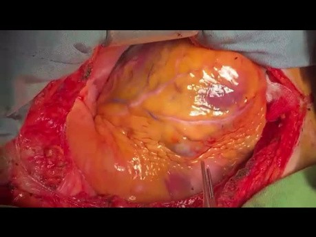 Off Pump CABG in patient with Colon Cancer and Simultaneous Colon Surgery 