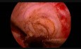 Hysteroscopic Management of Cesarean Scar Defect