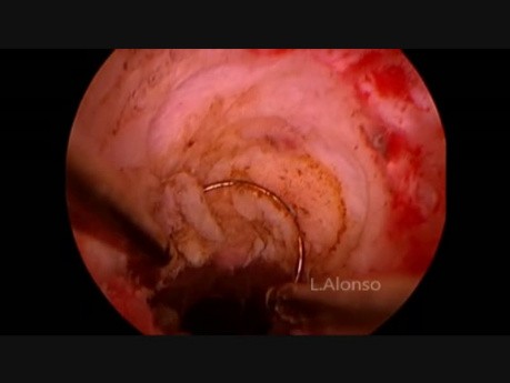 Hysteroscopic Management of Cesarean Scar Defect