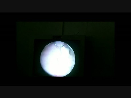 Leiomyoma of the Urinary Bladder