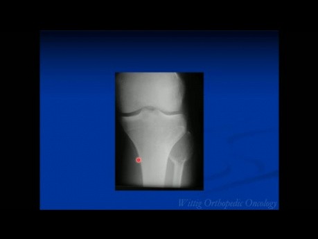 Orthopedic Oncology Course - Unknown Test Cases Part A (Cases 1-10) - Lecture 11