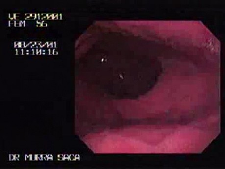 Reflux Esophagitis & Esophageal Stricture - Hiatal Hernia In Retroflexy