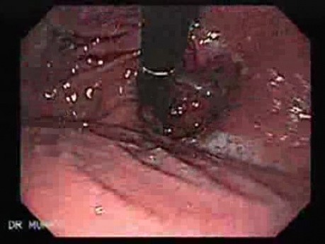 Barrett Adenocarcinoma (3 of 4)