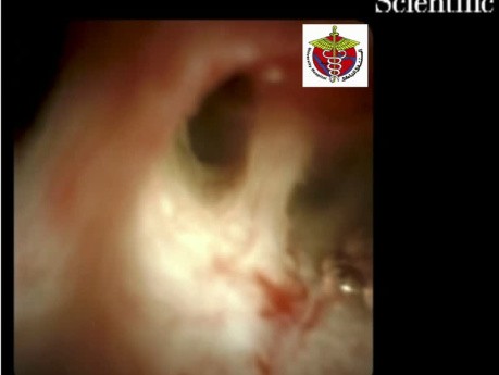 Primary Sclerosing Cholangitis on Peroral Cholangioscopy