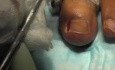 Stage-3 ingrown Toenail: Electrocautery