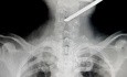 Spinal cord injury from spearfishing harpoon