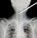 Spinal cord injury from spearfishing harpoon